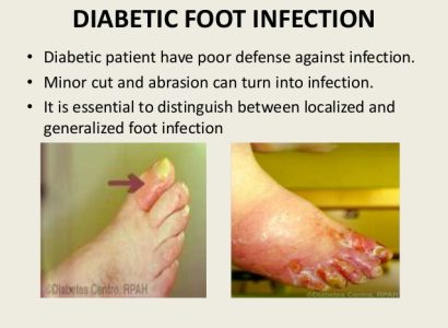 Gangrene diabetic-foot-disease